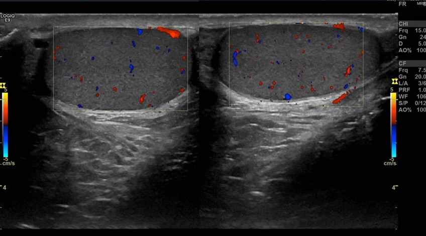 Ecograf a Doppler Color Testicular Brescia Ecograf a Doppler Color Testicular Brescia